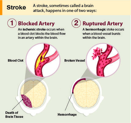 stroke illustration