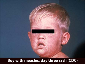 nMeasles-Day-3-Rash.png