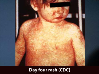 nMeaslesDay4Rash.png